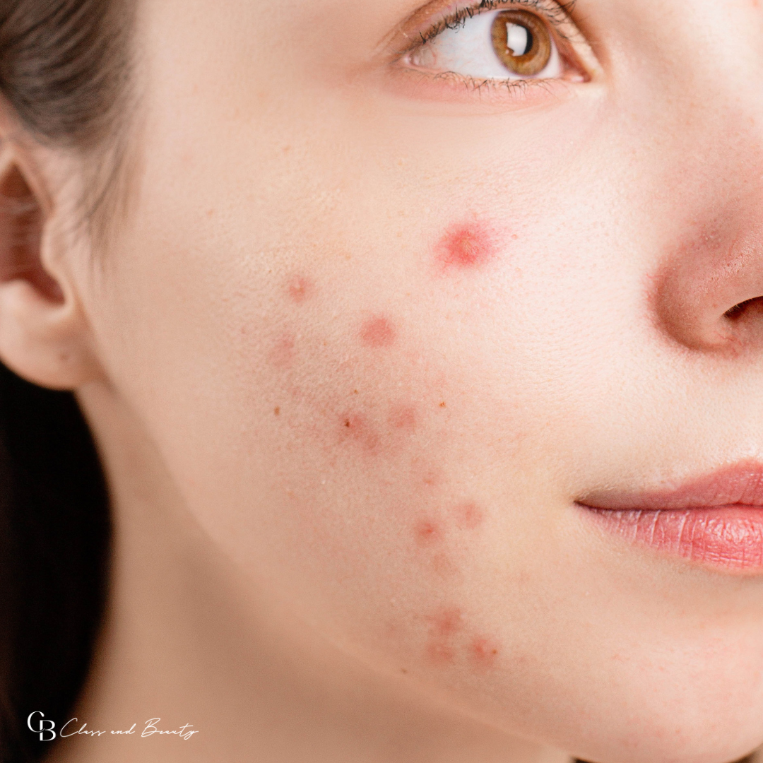 Close-up of acne and redness, showing the effects of a damaged skin barrier.